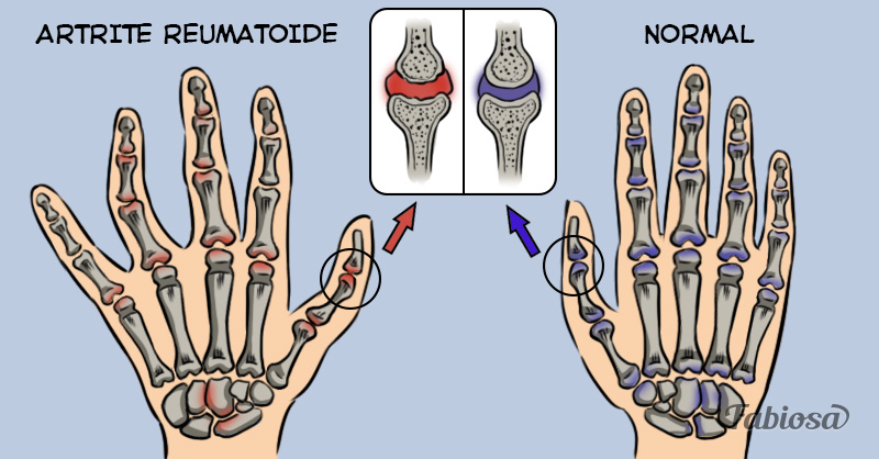O guia definitivo da artrite: o que é, como identificar e como tratar