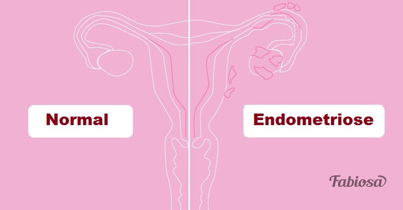 Endometriose: por que ela acontece, seus sintomas e como gerenciar essa condição