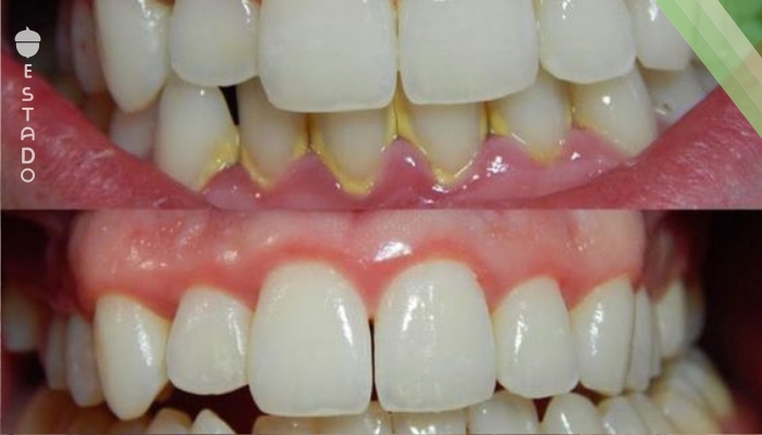 Sarro dental: cómo eliminarlo sin la ayuda de tu dentista