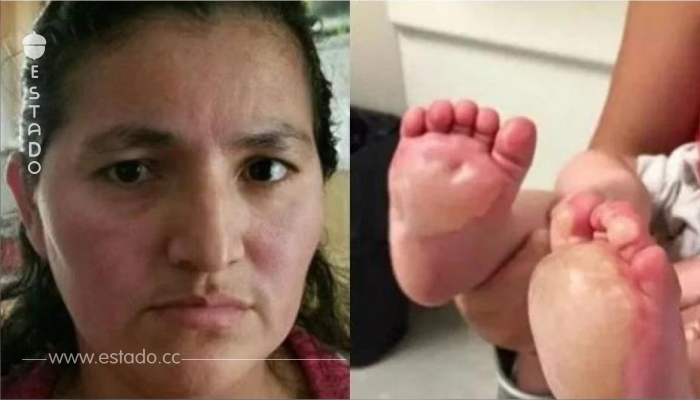 ¡Al ver estas horribles ampollas en los pies de su bebé, esta madre descubrió con horror lo que había hecho la babysitter!