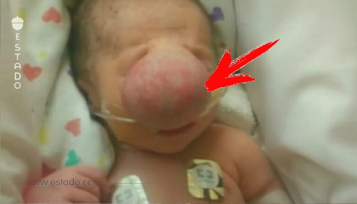 Doctores quitan enorme bulto de la cara de bebé – Lo que hay detrás hace que las lágrimas broten.
