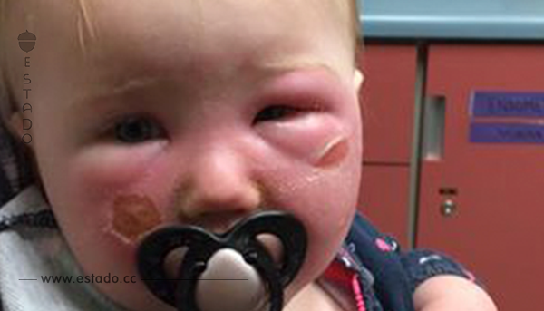 Una madre advierte a otros padres: después de aplicar una crema con filtro UV su bebé sufrió quemaduras de segundo grado.