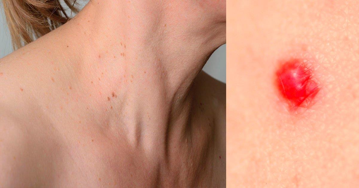 Te contamos qué significan y por qué se originan estos puntos rojos en la piel
