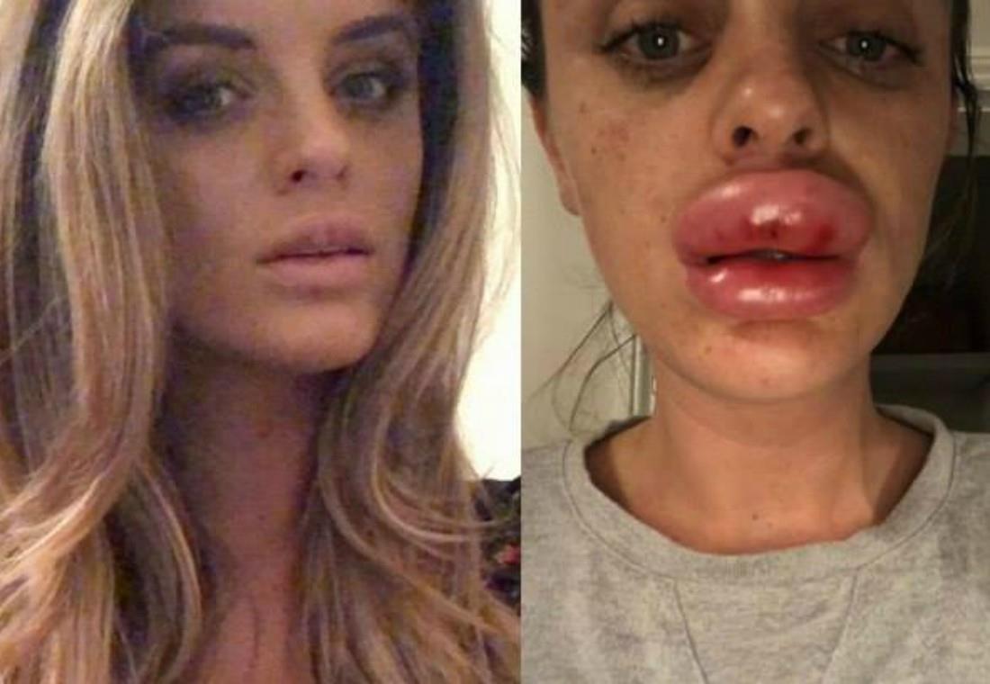 Los labios de esta mujer cuadruplicaron su tamaño luego de arruinarlos con relleno