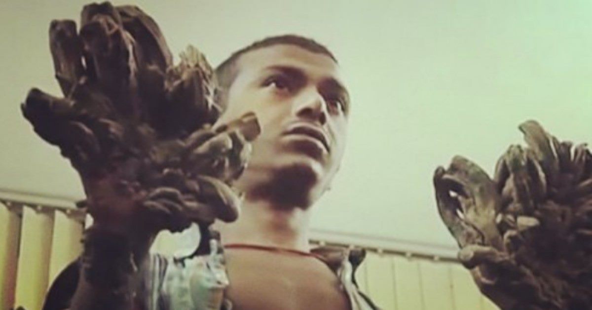 Desesperado por el dolor, 'hombre-árbol' de Bangladés pide que le amputen las manos