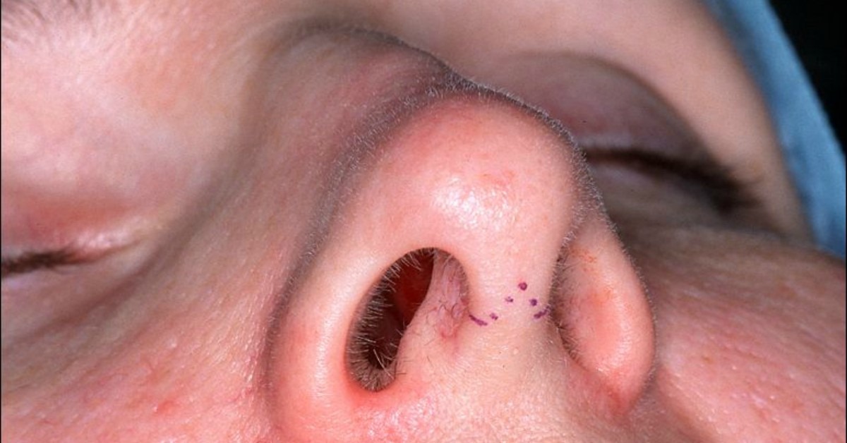 Mujer terminó con parte de su nariz amputada por error en cirugía estética