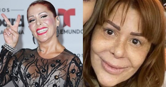 Alejandra Guzmán causa controversia por las cirugías fallidas en su rostro