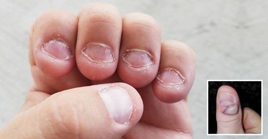 Morderse y comerse las uñas, un habito que puede causar la muerte: Onicofagia
