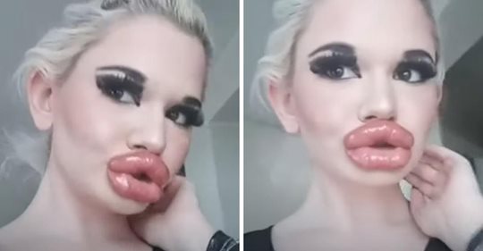Lo hizo de nuevo: la Barbie de la vida real  se inyecta los labios por vigésima vez