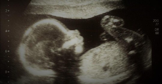 Un bebé nonato miró hacia la cámara y saludó con la mano durante una ecografía