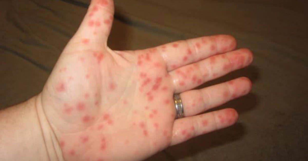 Si a tu hijo le aparecen estos puntos rojos por todo el cuerpo, necesitarás saber esto