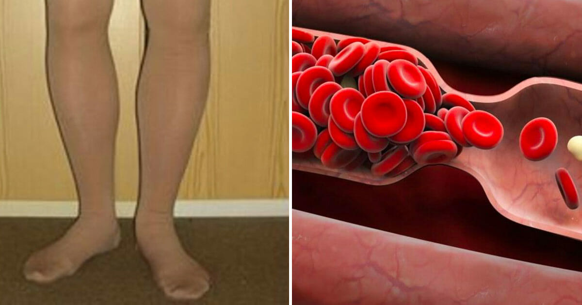 El cuerpo te advierte antes de una trombosis: 8 señales ocultas que nunca debes ignorar