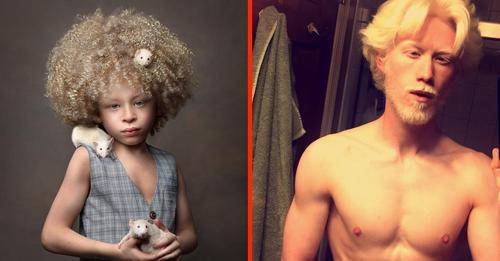 El albinismo y sus encantos: 13 personas nos revelan su belleza